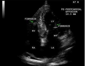 Figure 45. Endomyocardial fibrosis showing thickening of LV tendons seen as fibrous ridges as an initial manifestation of LV EMF in a 23-year-old male