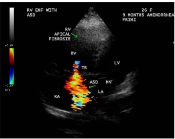 Figure 48. RV EMF with ASD showing tricuspid regurgitation in a 26-year-old female antena-tally (Primi with 9 months amenorrhea)
