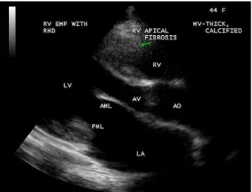 Figure 55. RV EMF with Rheumatic mitral valve involvement in a 44-year-old female-apical four chamber view