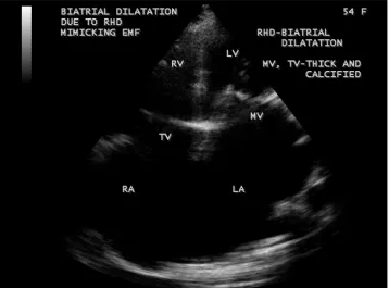 Figure 57. Biatrial enlargement due to rheumatic AV (atrioventricular) valve stenosis (mitral stenosis, tricuspid stenosis)—in contrast to EMF as shown in Figure 34 which is associated with AV valve regurgitation