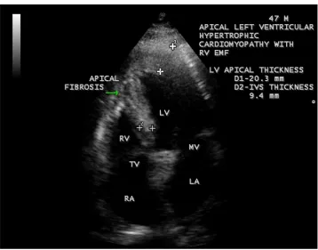 Figure 60. RV EMF with mild pericardial effusion and mitral valve involvement in a 55-year-old male with AV (atrioventricular) valve regurgitation
