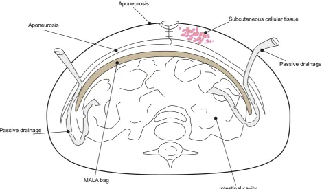 Figure 1 - Schematic representation of the MALA bag insertion.