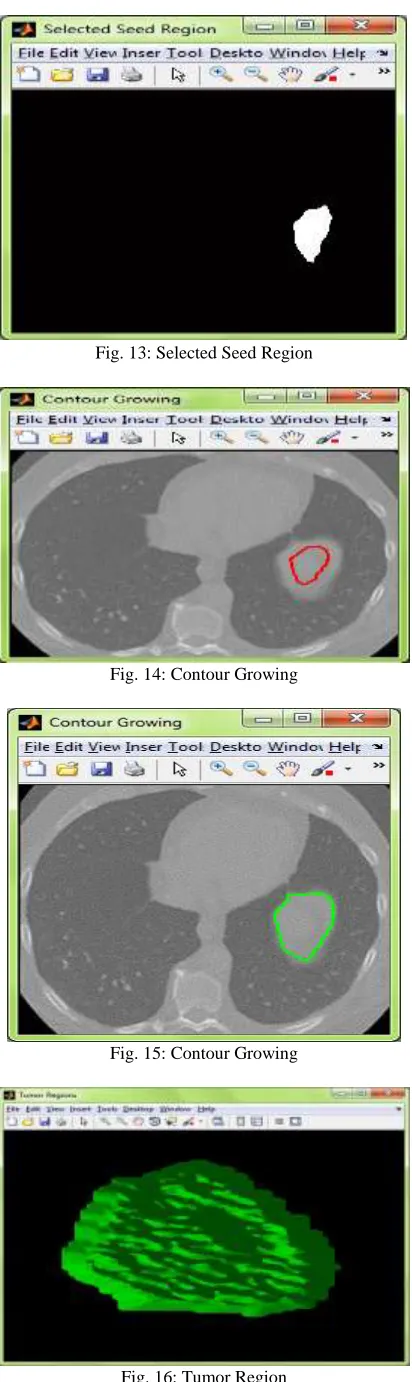 Fig. 16: Tumor Region 