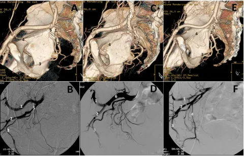 Figure 1 - Branching patterns of the internal iliac artery. Note that 3 main collaterals arise from the internal iliac artery at a common origin