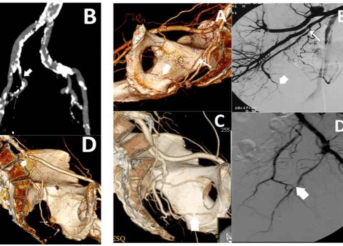 Figure 5 - Examples of lesions found on the internal pudendal ar-teries. 