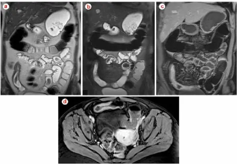 Fig. 4 – Coronal T2-weighted SSETSE non-fat suppressed (a) and fat suppressed (b), and coronal immediate (c) and axial 60 second (d) post gadolinium T1-weighted 3D GRE fat suppressed images in a 47-year old woman