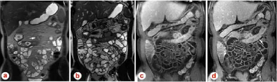 Fig. 7 – fluid collections.  Coronal post gadolinium images (d) show marked mucosal and serosal (arrows, d) enhancement consistent with acute Coronal T2-weighted SSETSE non-fat suppressed (a), coronal steady state free precession (b) and 2-minute and 2,5-m