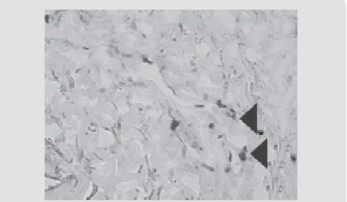 Figure 5: Patient D., 34 year sold, 5th day of observation. Active  marginal  epithelization