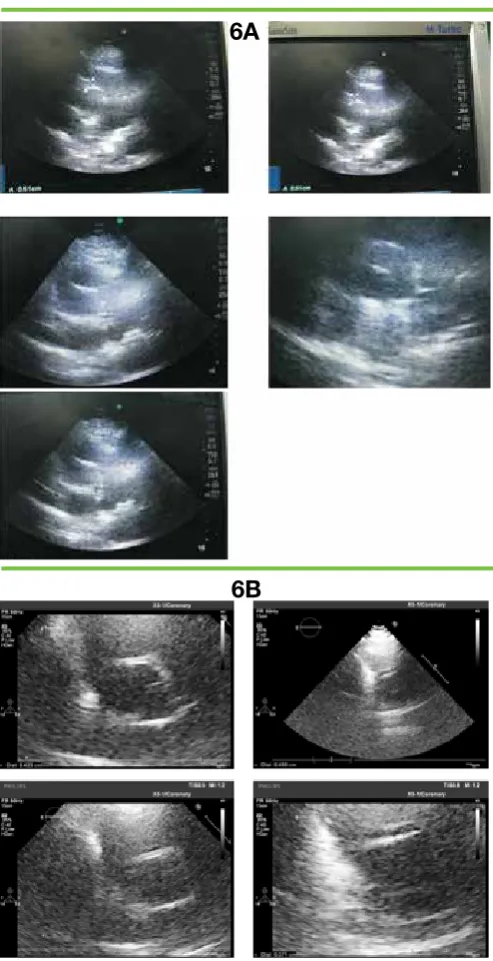 Table 2. Baseline characteristics of patients underwent patent ductus arteriosus closure.