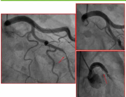 Figure 5.choose the right dimensions of the stent;, to verify the complete 