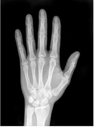 Fig 6.1 Noise removed X-ray  