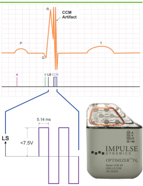 Figure 2. The Optimizer™ System for Cardiac Contractility Modulation (CCM™) applies non- excitatory signals during the absolute refractory period