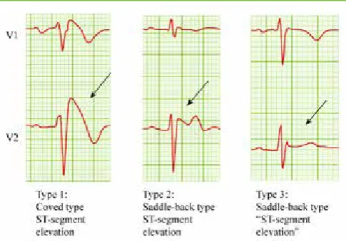 Figure 1. Topology of the SCN5A with mutations locations and their associated disorders