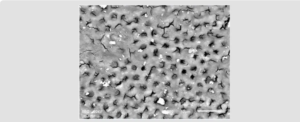 Figure 2a: SEM micrographs (2000 x) of the precipitate on the surface of dentin root canal after EDTA+ CHX irrigation in appical third.