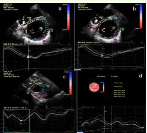 Figure 2. Circunferential Strain curves,  a) Basal short axis view, b) midpapillary muscle  short axis view,  c) apical  short axis view