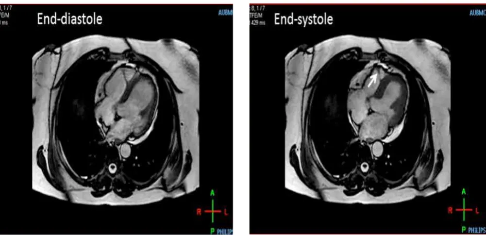 Figure 4: Fibro-fatty infiltration of the LV wall 