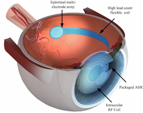 Figure 1.2: The intraocular system of retinal prothesis. Courtesy of Dr. Damien Rodger.