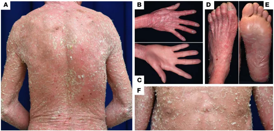 Figure 1. Clinical features of the IWC-I patient. (A–F) The patient presented with diffusely erythematous skin with scales on the whole body, except for the palms (C)