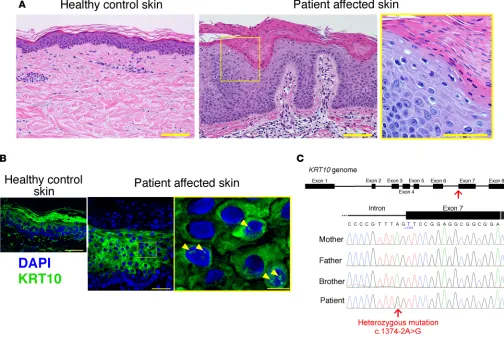 Figure 2. Histological and genetic features of the patient. (stratum corneum, was thicker (center panel)