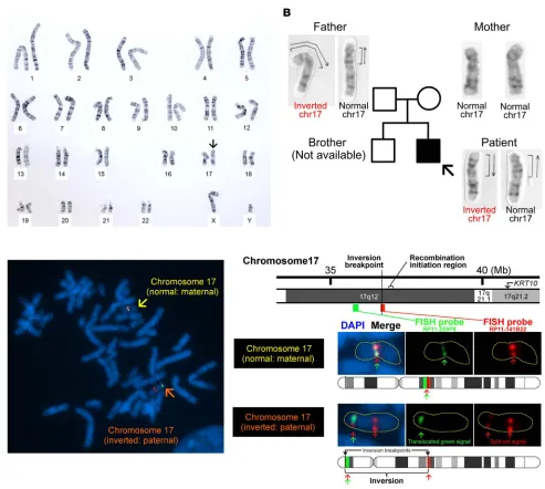 Figure 4. Detection of inv(17)(p13q12) and its breakpoints. (A) G-banded karyotype analysis using peripheral blood lymphocytes from the proband revealed that the patient was heterozygous for a pericentric inversion (arrow), inv(17)(p13q12)