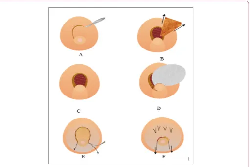 Figure 5: Stages of Surgical Access and Techniquepoints of soft. External silicone pieces over the dermis flap