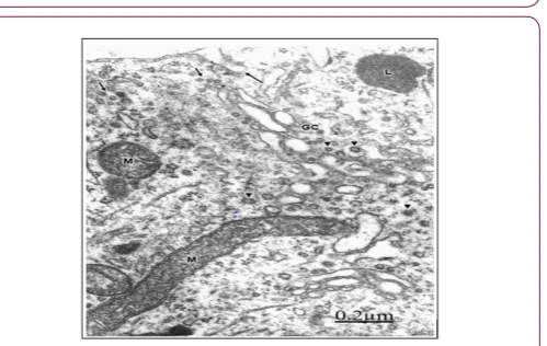 Figure 3: Congenital hydrocephalus. Right frontal cortex. Non-pyramidal neuron exhibiting fragmented plasma membrane (long arrow), distended endoplasmic reticu-lum cisterns (ER), detachment of membrane associated ri-bosomes (short arrows), and disassembly 