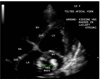 Figure 34. Short axis view showing the vegetation masses in the tips of mitral valve leaflets