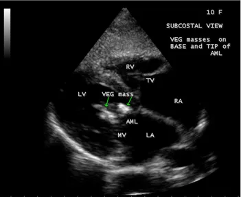 Figure 37. MR (mitral regurgitation) jet originating from the tip of AML (anterior mitral leaflet) at the site of attachment of vegetation into LV (left ventricle)