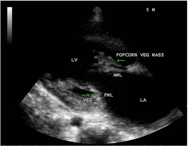 Figure 38. A “popcorn” like vegetation attached to AML in a 5-year-old febrile boy—moving in-to the LV along with the leaflet