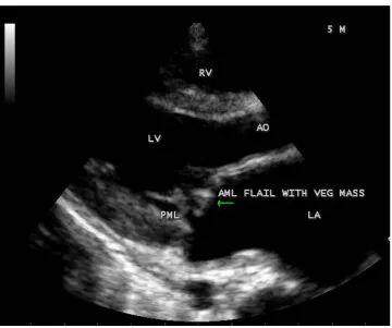 Figure 40. Chordal rupture and “flail” AML in the 5-year-old boy. 