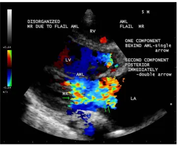 Figure 42. Vegetation mass attached to the base of AML in the 5-year-old boy. 