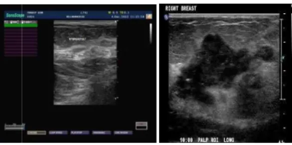Fig. 2: Original ultrasound breast image