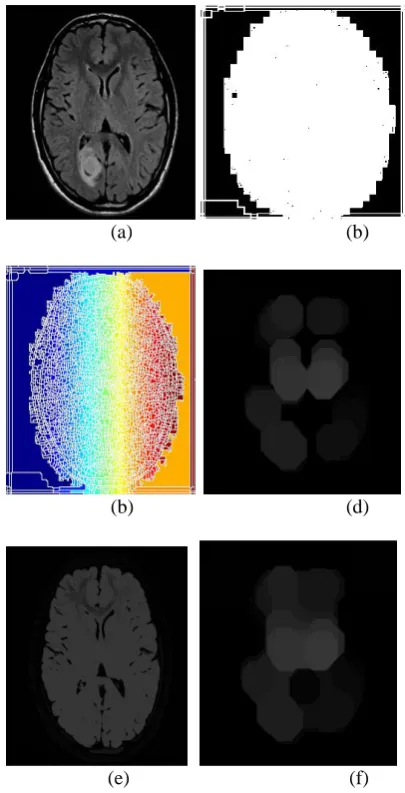 Fig 8. (a) Original Image (b) Gradient Magnitude (c) Mark the foreground objects (d) opening-by-reconstruction (e) complement the image (f) closing-by-reconstruction 