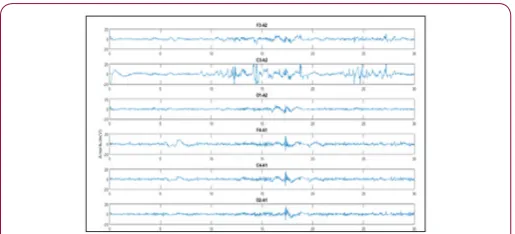 Figure 2: Example of a 30sec epoch for each channel acquired from Patient 1.