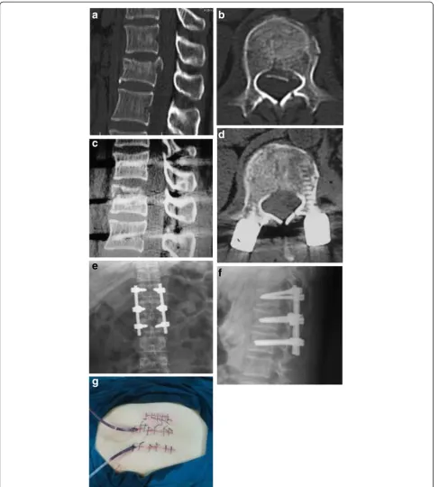 Figure 12 Images obtained in a 38-year-old woman who underwent direct decompression followed by percutaneous short-segmentfixation: (a) Preoperative sagittal sectional CT; (b) Preoperative cross-sectional CT; (c) Postoperative sagittal-sectional CT; (d) Postoperativecross-sectional CT; (e) Postoperative anteroposterior X-ray; (f) Postoperative lateral X-ray; (g) Longitudinal incision next to erector spinae.