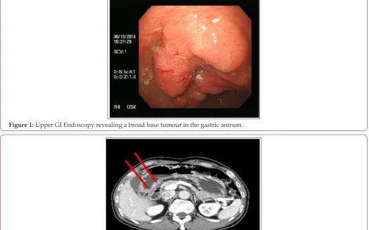 Figure 2: Computed tomography revealing mass at the stomach antrum and enlarged LN in hepatoduodenal ligament.