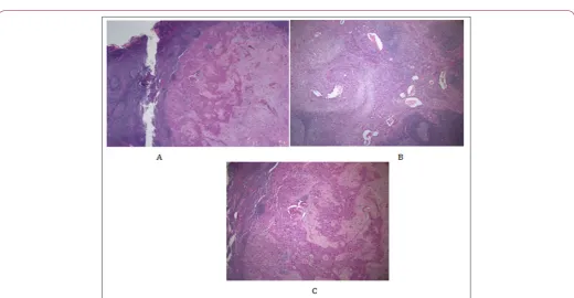 Figure 5: Microscopic observation of the tumour (hematoxylin and eosin A x20 and B x40) showing moderately differentiated tubular adenocarcinoma.