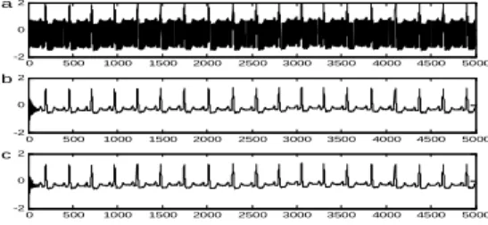 Fig. 4: PLI cancellation  using different adaptive algorithms.(a) Corrupted ECG (b)  using  BLMS   algorithm        (c)FB-LLMF algorithm