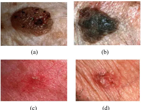 Figure 1: Difficulties in detecting lesions: (a) multiple colored lesions, (b) presence of hair, (c) smooth transition between lesion and skin, (d) specular reflections  