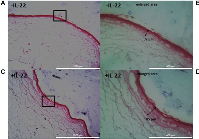 Figure 3. Histology H&E staining of22 treated LSE, “psoriatic skin,” char-acterised by wavy acanthosis