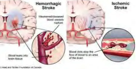 Figure 2.1: hemorrhagic and ischemic stroke (By Leslie Ritter) 