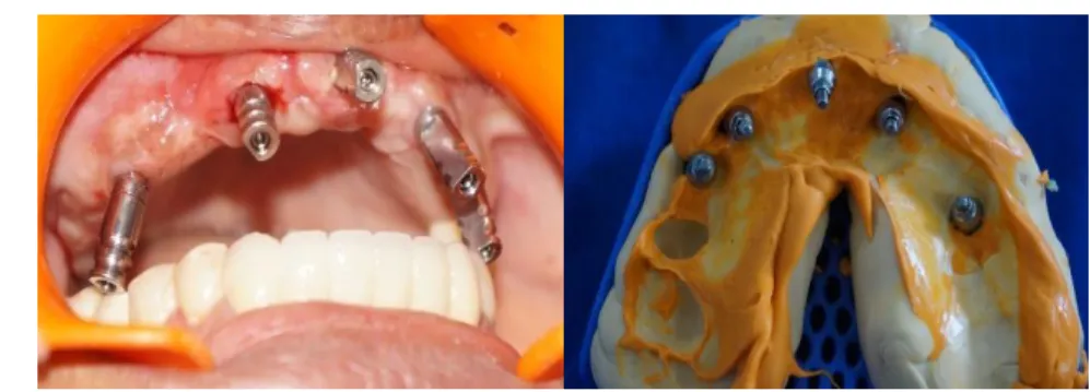 Fig 1 indirect impression 