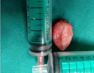 Figure 3. (a) Picture showing in immediate post operative periodon nasal doscopic picture showing the site of lesion with arrow on immediate follow endoscopy arrow showing minimal crusts at the site of lesion; (b) nasal en-up period