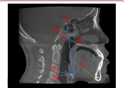 Figure 8: The measurement defining the position of hyoid bone; a. HyS: linear vertical distance from Hy (uppermost point of the hyoid) to S; b