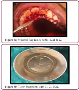 Figure 3a: Mucosal flap raised with 11, 21 & 22.