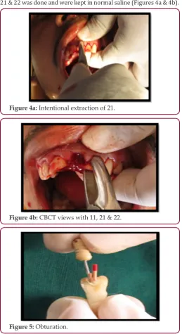 Figure 4a: Intentional extraction of 21.