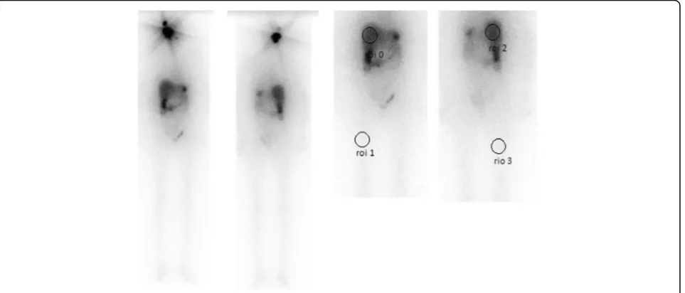 Table 3 A. Comparison of HTR obtained from anterior image and that obtained from posterior image B
