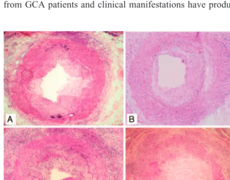 FIGURE 1. Active histological inﬂammatory patterns involvingtemporal arteries in giant cell arteritis (GCA)