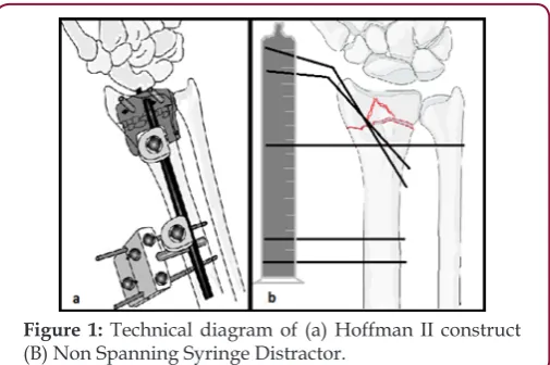 Figure 1: Technical diagram of (a) Hoffman II construct (B) Non Spanning Syringe Distractor.
