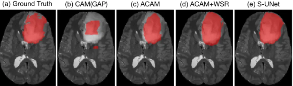 Fig. 2. Qualitative results on BraTS dataset showing extracted lesion volumes by (a) ground truth, (b) CAM(GAP), (c) the proposed ACAM, (d) the proposed ACAM+WSR and (e) fully supervised S-UNet.
